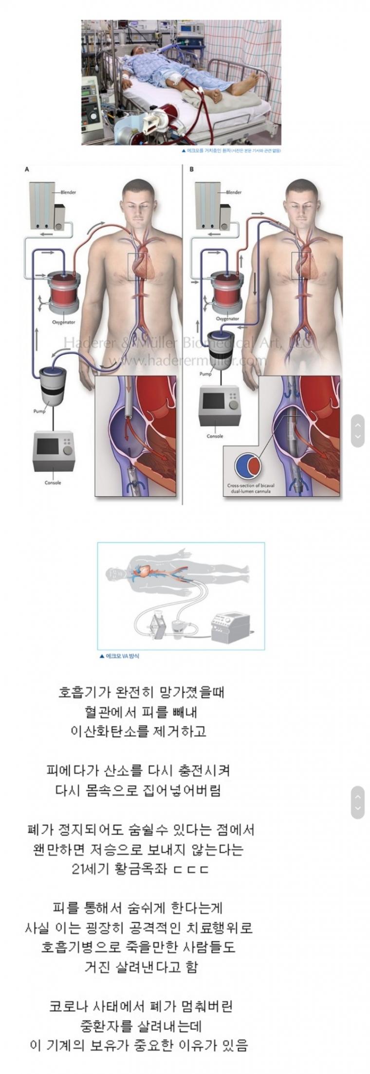 Ekmo, the 21st century's ultimate therapeutic weapon that saves a broken lung.