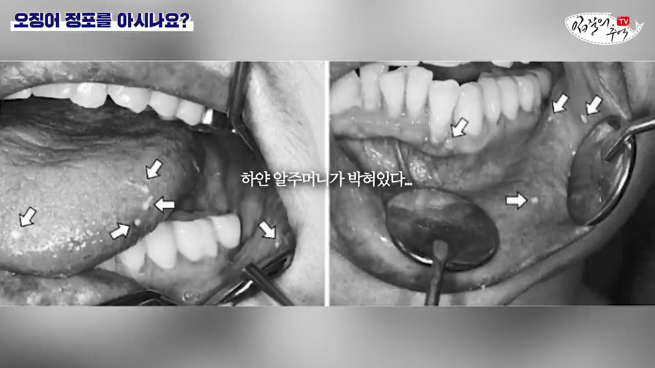 오징어 먹을때 주의해야 할 것