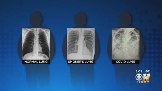 맨오른쪽이 코로나 환자의 폐