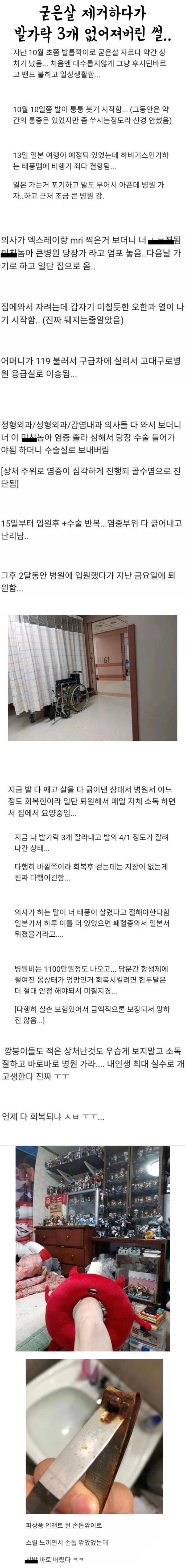 굳은살 제거하다가 발가락 3개 없어짐