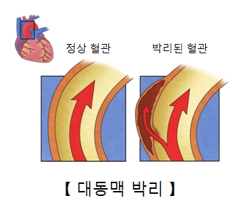 베르세르크 작가 분 사망원인