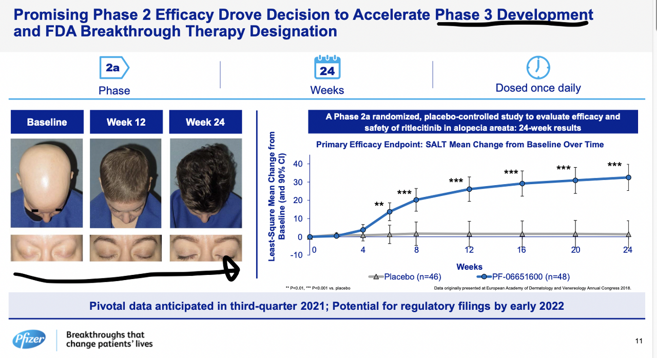 Pfizer's hair loss clinical treatment