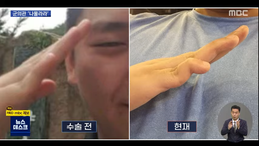 군대에서 수술받고 손가락 영구장애