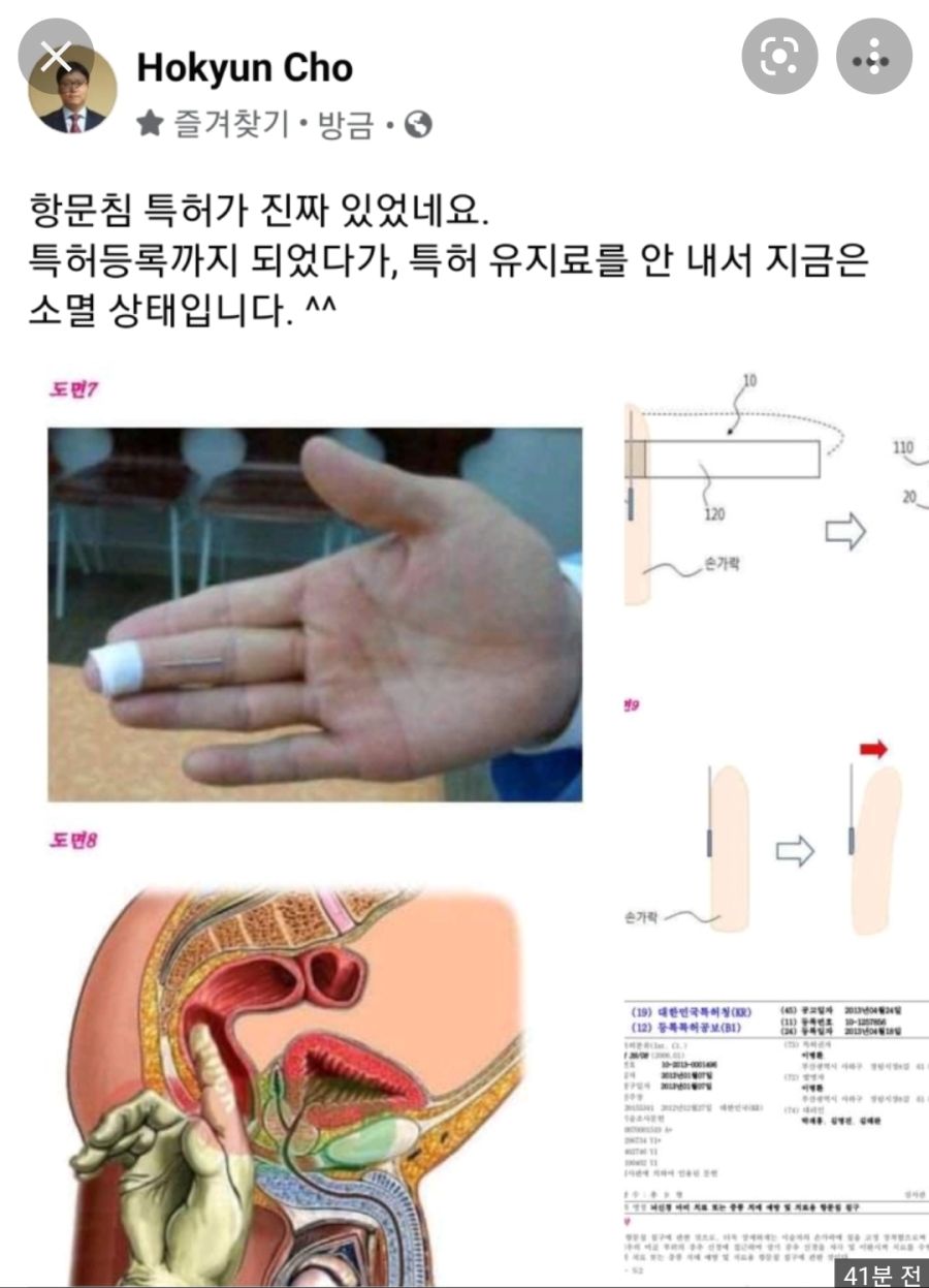 특허받은 항문침이라 이걸 말하는거