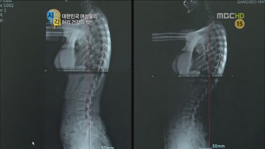 가슴 성형 의혹에 엑스레이 공개한 유명인들