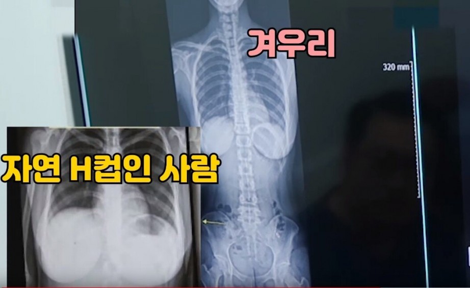 가슴 성형 의혹에 엑스레이 공개한 유명인들