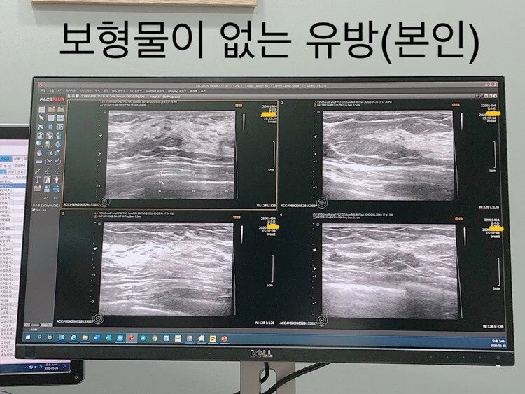 가슴 성형 의혹에 엑스레이 공개한 유명인들