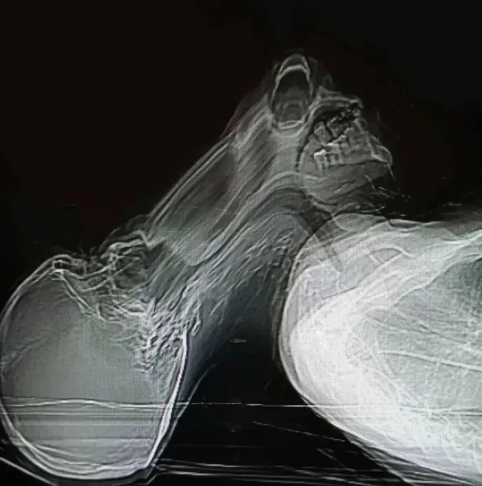 A patient with panic disorder during CT scan.