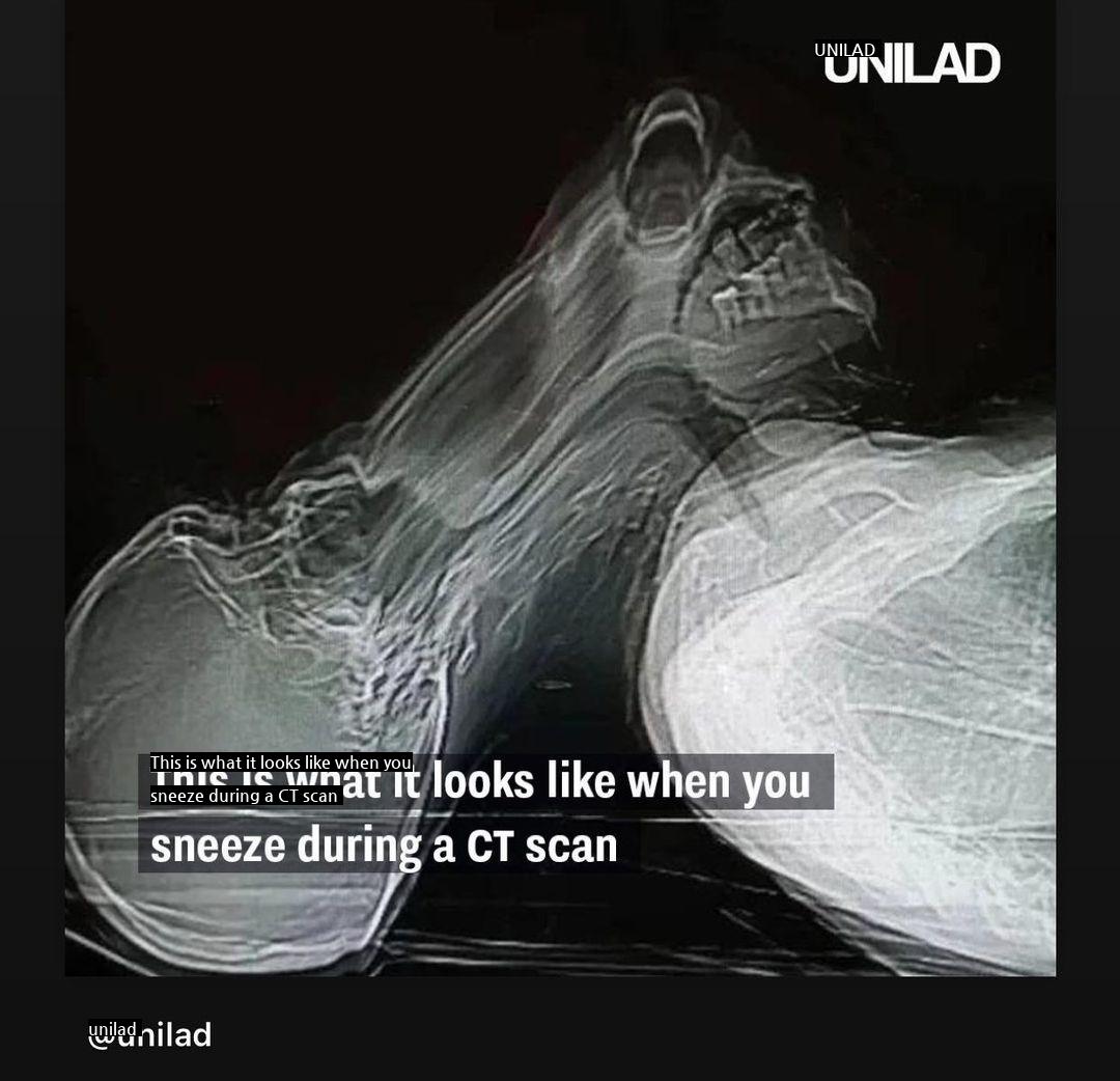 CTの撮影中にくしゃみをすると起こること。