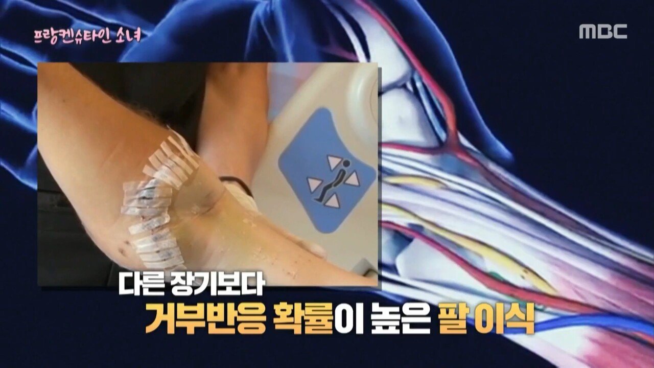 남자의 팔을 이식한 프랑켄슈타인 소녀