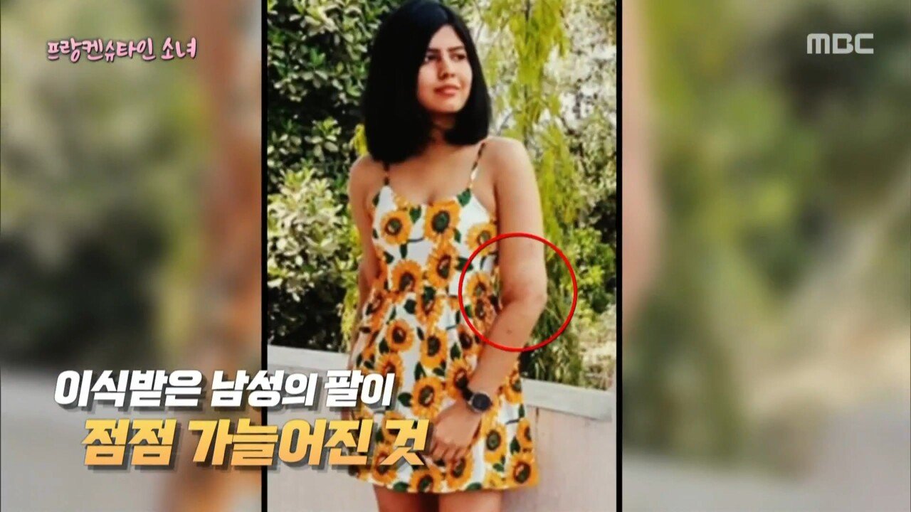 남자의 팔을 이식한 프랑켄슈타인 소녀