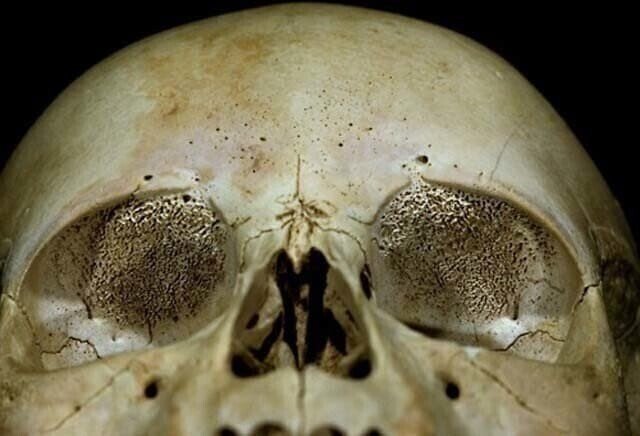 嫌悪骨がん患者の頭蓋骨jpg