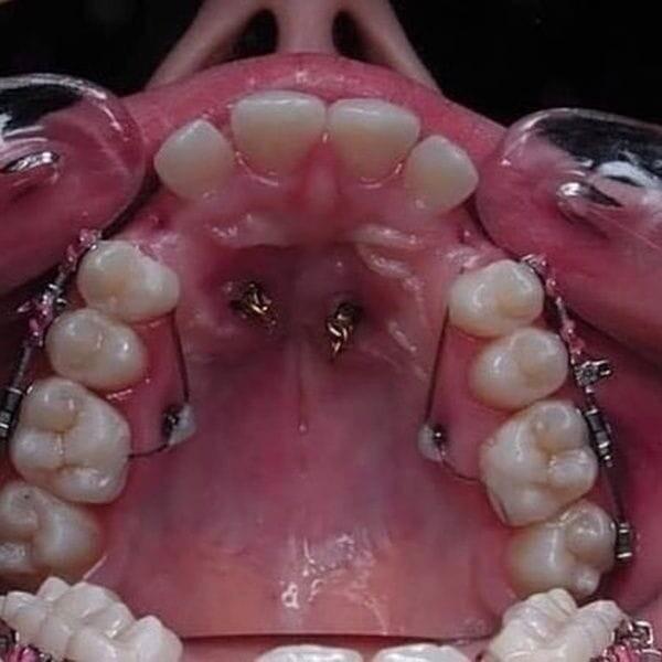 歯の矯正がすごい理由