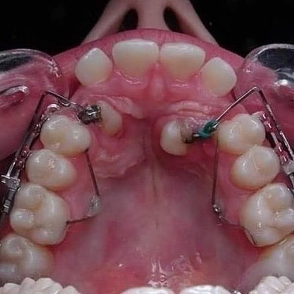 歯の矯正がすごい理由