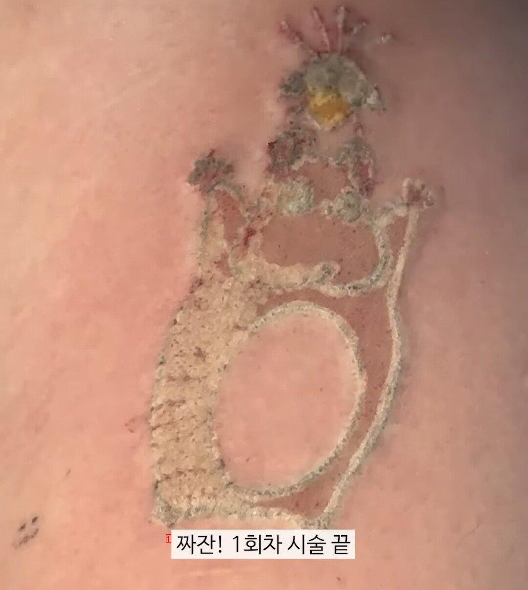 약혐) 귀여운 문신제거 시술하는 영상......GIF