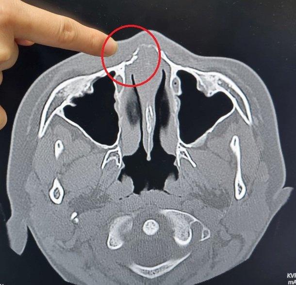 講師に食ってかかる途中、一発殴られて鼻の骨が折れた中学生。