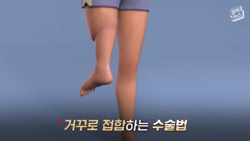 의사가 발 거꾸로 붙여줬는데 고마워서 울었다는 남성