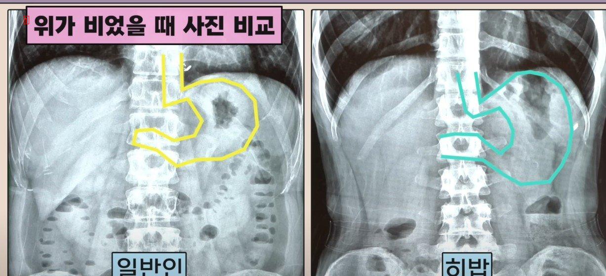 히밥의 엑스레이 사진을 본 의사들도 처음본다는 위크기
