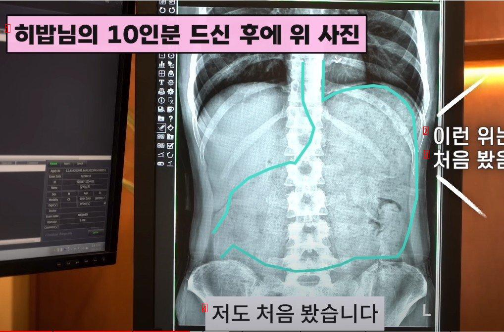 히밥의 엑스레이 사진을 본 의사들도 처음본다는 위크기