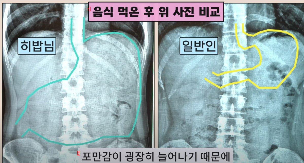 히밥의 엑스레이 사진을 본 의사들도 처음본다는 위크기