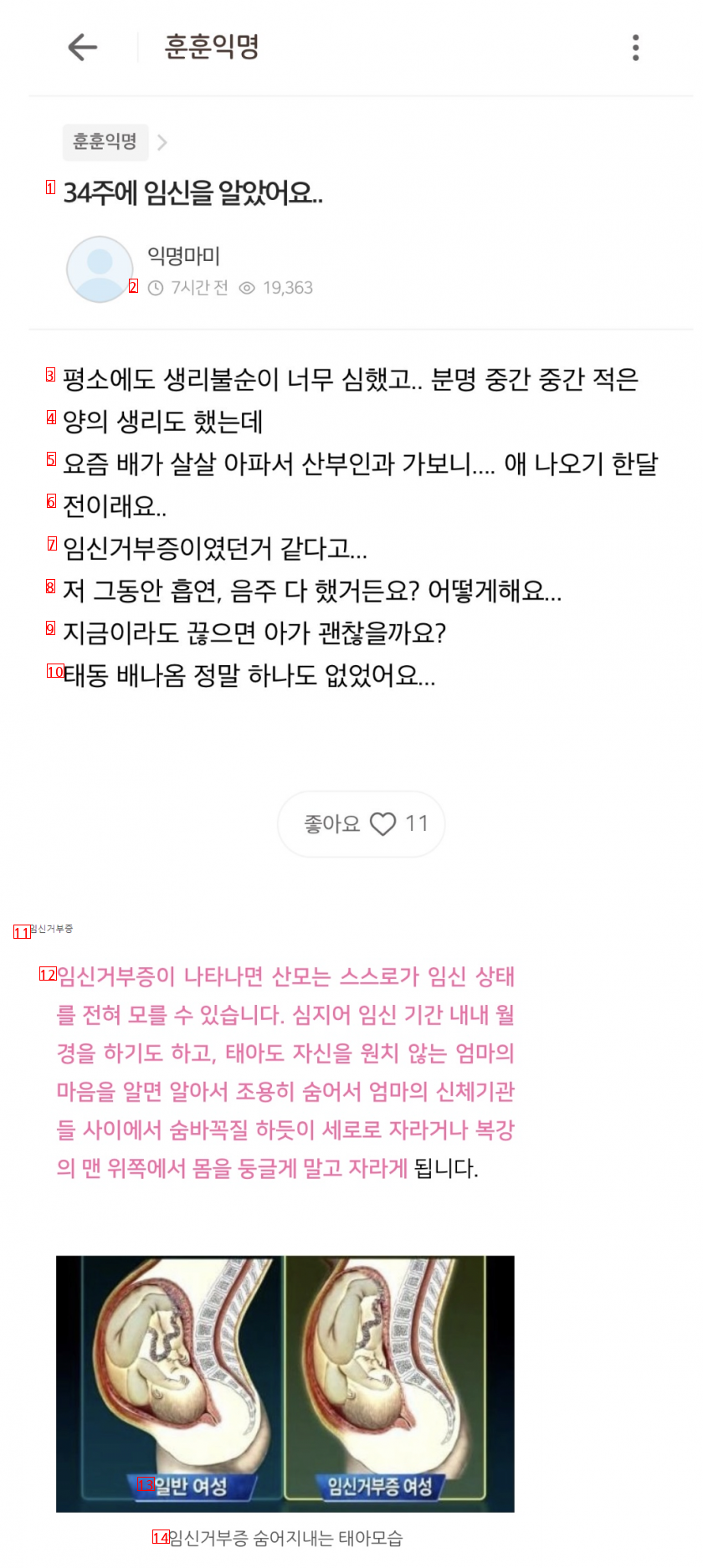 34주 만에 임신인 알았다는 여성 ㄷㄷ