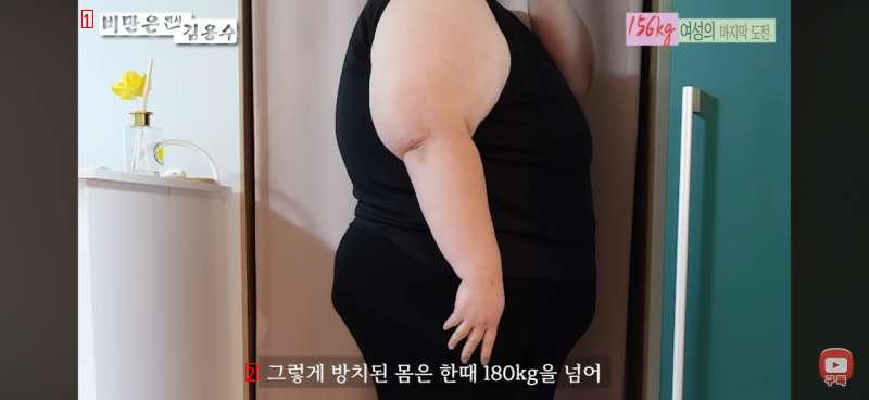 156kg 초고도 비만여성