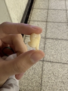 일본에서 화제가 된 어느 모델의 사랑니