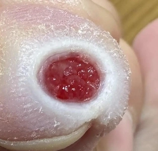 혐) 티눈갤러리 칠성장어 갤주 근황.jpg