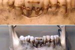 (약혐) 4000년 된 미라에서 발견된 치과 작업...jpg