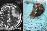 코요태 빽가 뇌종양 당시, MRI 사진